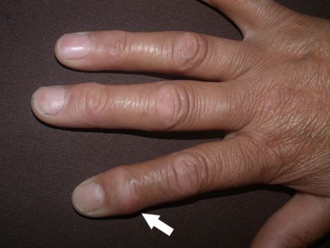 rheumatoid arthritis thumb