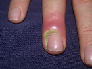 finger infection