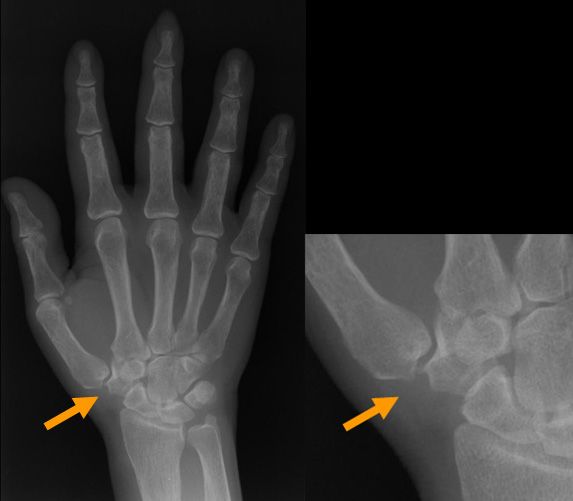 Hand Surgery Turkey Calcification On Thumb Base Ostheoarthritis Of